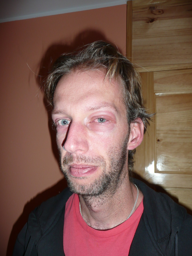 Swelling after it had gone done a bit already. Steroids are good!